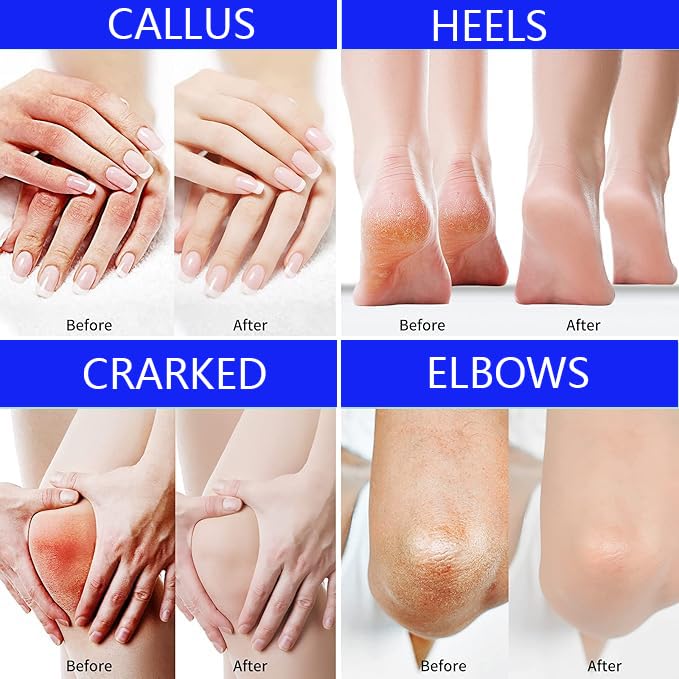 Urea Cream foot cream, 40 percent Foot Care Lotion for Cracked Heels,Moisturizing，Cracked Heels, Ultra,Rough, Dry, Calloused Feet,Softening Rough skin on feet for All Skin 5.29 fl.oz