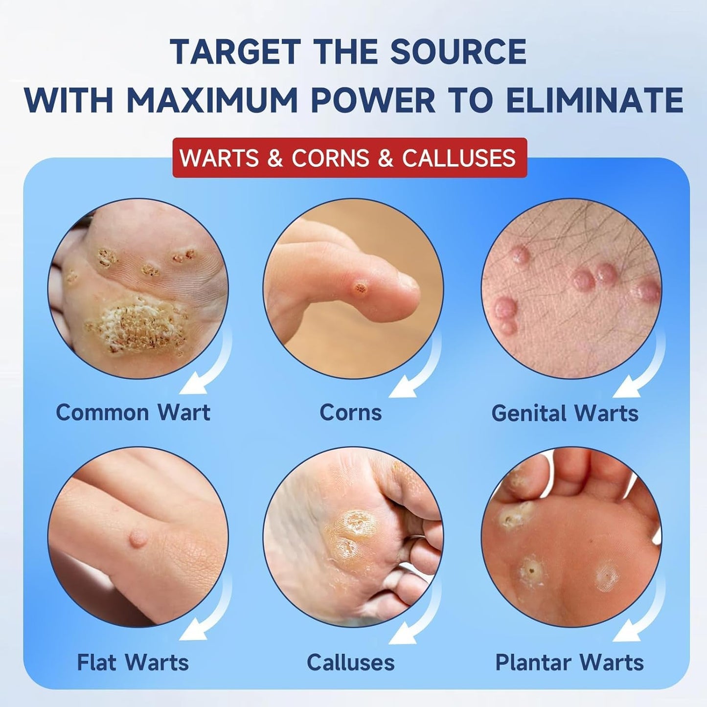 Fast-Acting Skin Tag Remover Wart Remover with Salicylic Acid, Wart Removal for Women Men, Wart Freeze Off for Plantar Wart, Flat, Common, Corn,H Wart, Callus 30ML