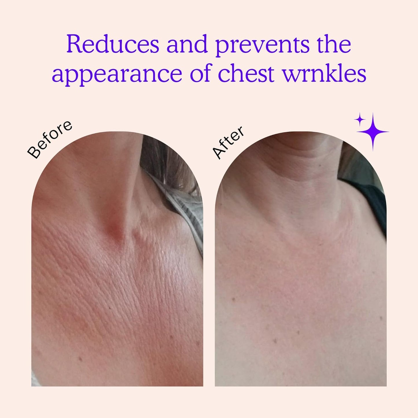 BLUMBODY Chest, Neck Wrinkle Pads – Anti-Wrinkle Silicone Patches Skin Firming, Smoothing – Reusable Overnight Pad – Anti-Aging Crepe Erase Pads – Neck, Décolleté (1-Month Supply)