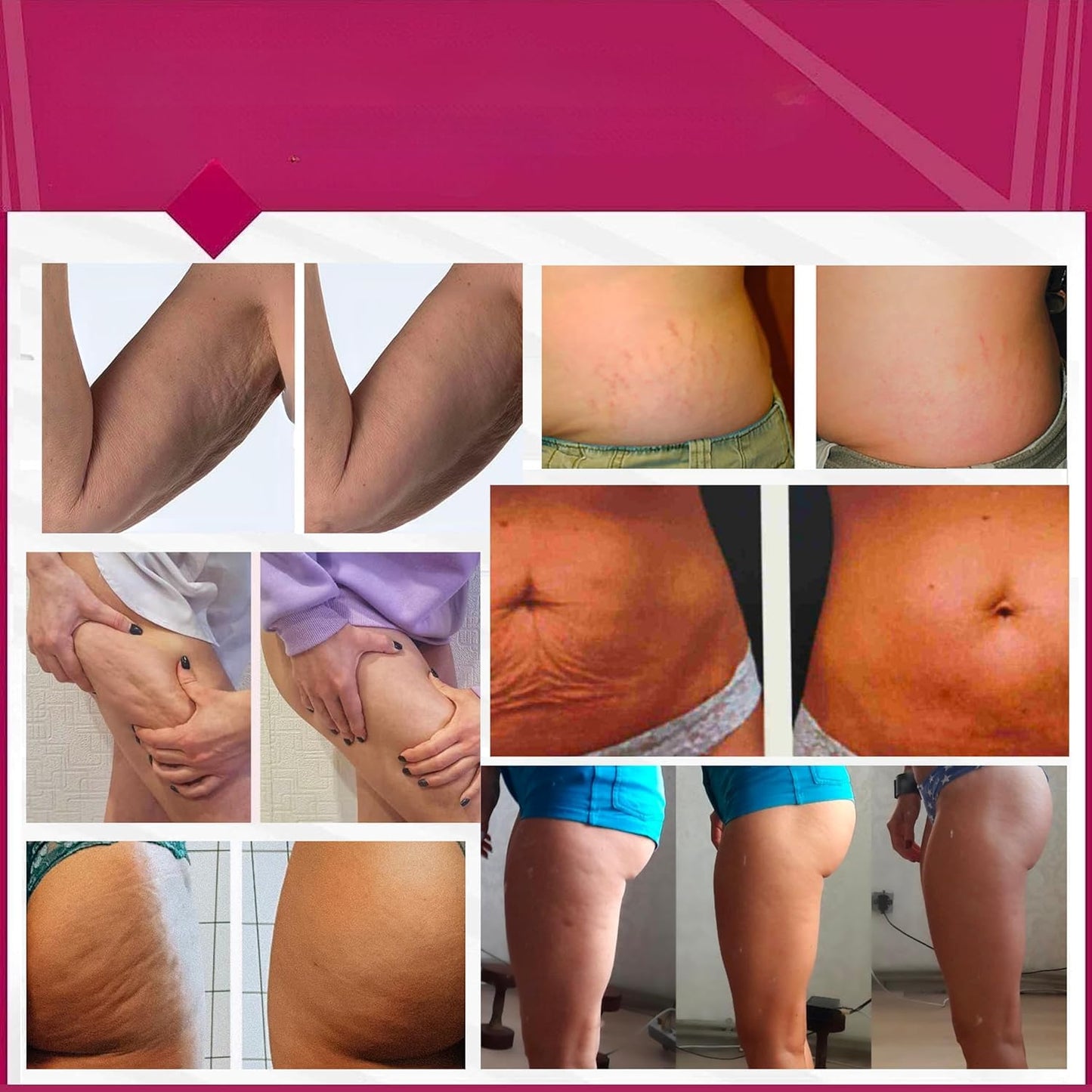 Anti-Cellulite Advanced Hot Body Cream Gel For Even Skin and Elasticity. Anacis - 5.07 Oz