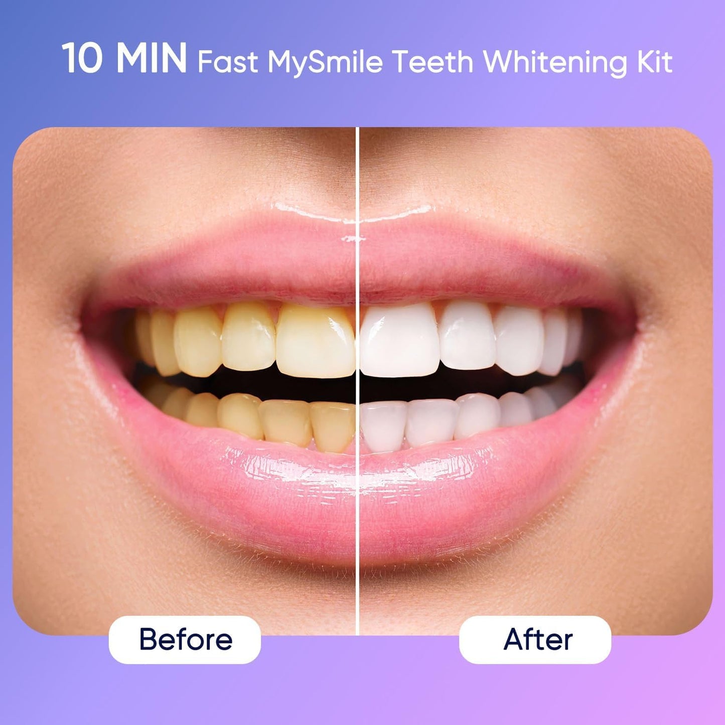 MySmile Deluxe 10 Min Teeth Whitening Kit with 28 LED Light, 35% Carbamide Peroxide Teeth Whitening Gel, Helps Remove Years of Stains from Coffee, Soda, Wines, Smoking, Food