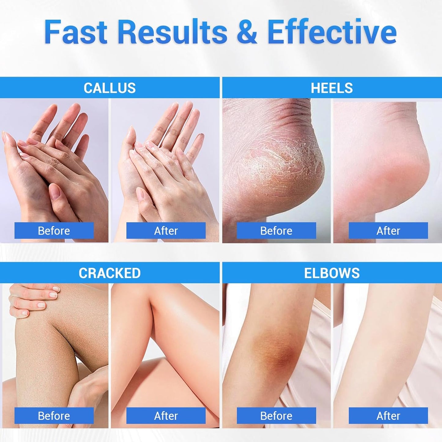Urea Cream 40 Percent for Feet Maximum Strength, Foot Cream for Dry Cracked Heels Feet Knees Elbows Hands, Urea 40% Cream for Deep Moisturizes, Callus Remover, Heel Crack Repair