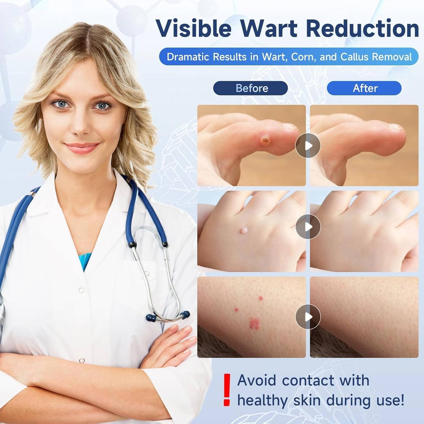 Fast-Acting Skin Tag Remover Wart Remover with Salicylic Acid, Wart Removal for Women Men, Wart Freeze Off for Plantar Wart, Flat, Common, Corn,H Wart, Callus 30ML