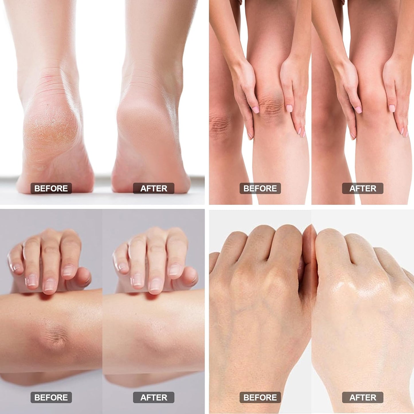 Urea Cream 42% - Foot Care for Dry Cracked Heels, Foot Lotion - With 2% Salicylic Acid, Tea Tree Oil, Shea Butter, Aloe Vera - For Feet, Hands, Heels, Elbows, Knees and More - 6 oz