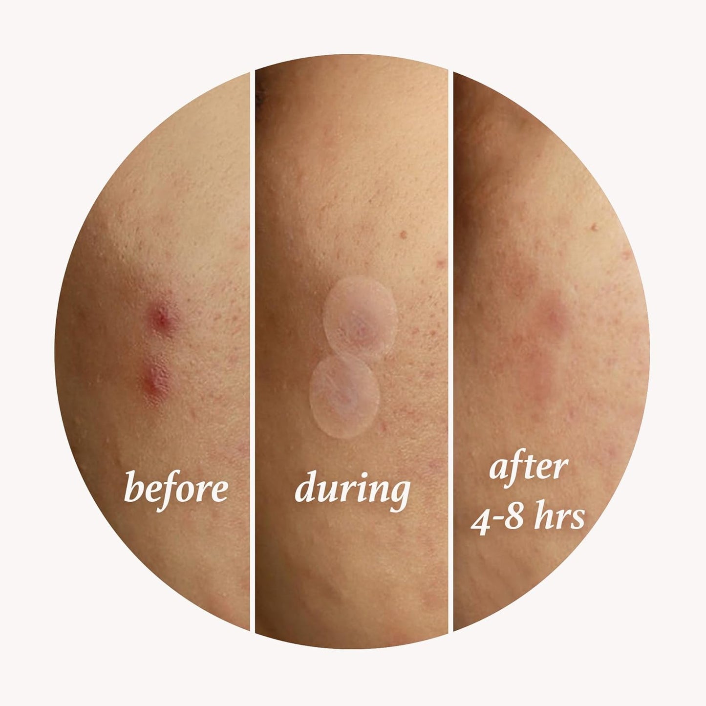 Julep Patch Me Up Waterproof Pimple Patches for Face – 72 Hydrocolloid Clear Acne Patches with Tea Tree Oil, Ultra-Thin Acne Stickers, Reduces Blemishes & Scarring – 48 8mm & 24 12mm Patches