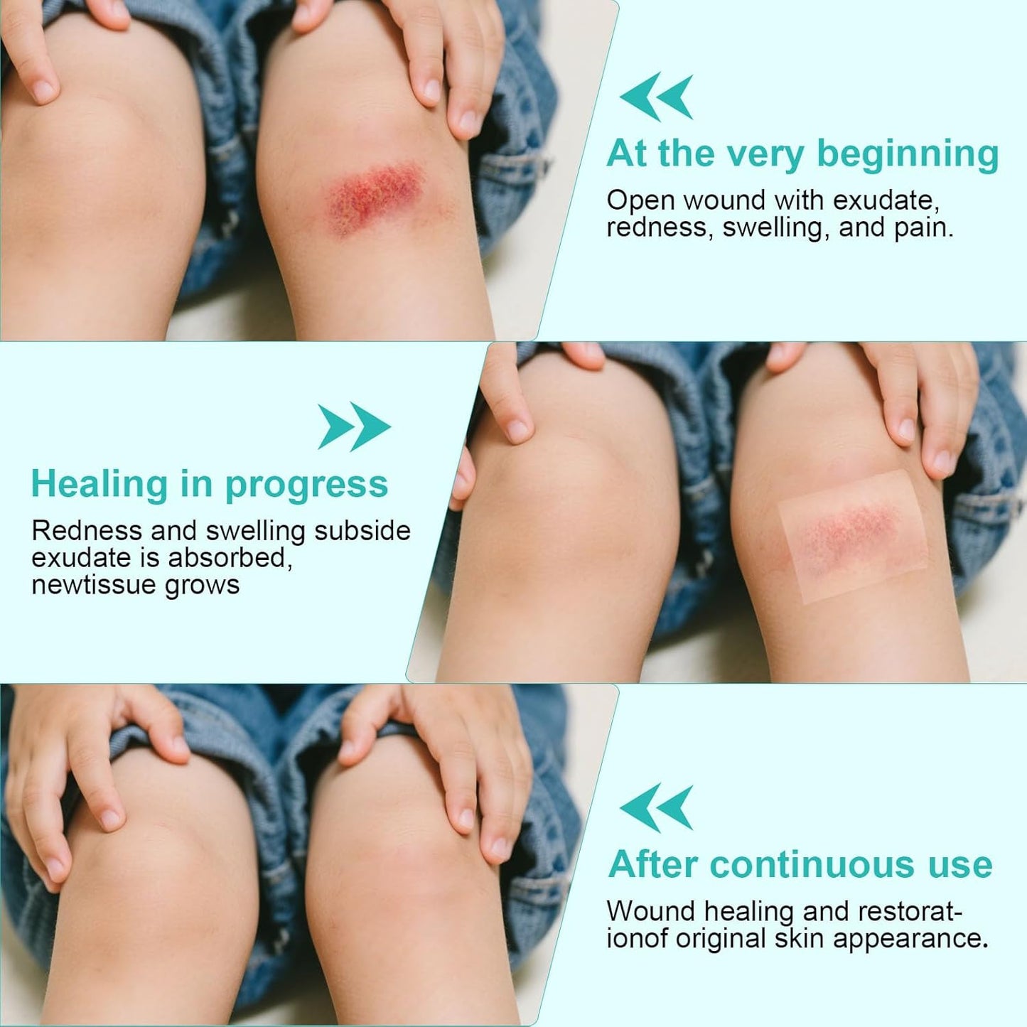 Hydrocolloid Roll, Medical-Grade Hydrocolloid Bandages for Wound Care, Extra Large Hydrocolloid Patch Bandages with Self-Adhesive, Cut-to-Size, Flexible Waterproof,First Aid Kit Essential(2in*16.4ft)