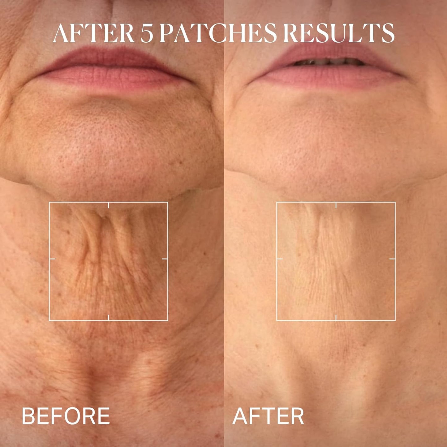 depology Tightening and Lifting Neck Wrinkle Patches with Cream, PDRN Deep Collagen Neck Mask, Firming Patch with PDRN、Collagen and Niacinamide Cream