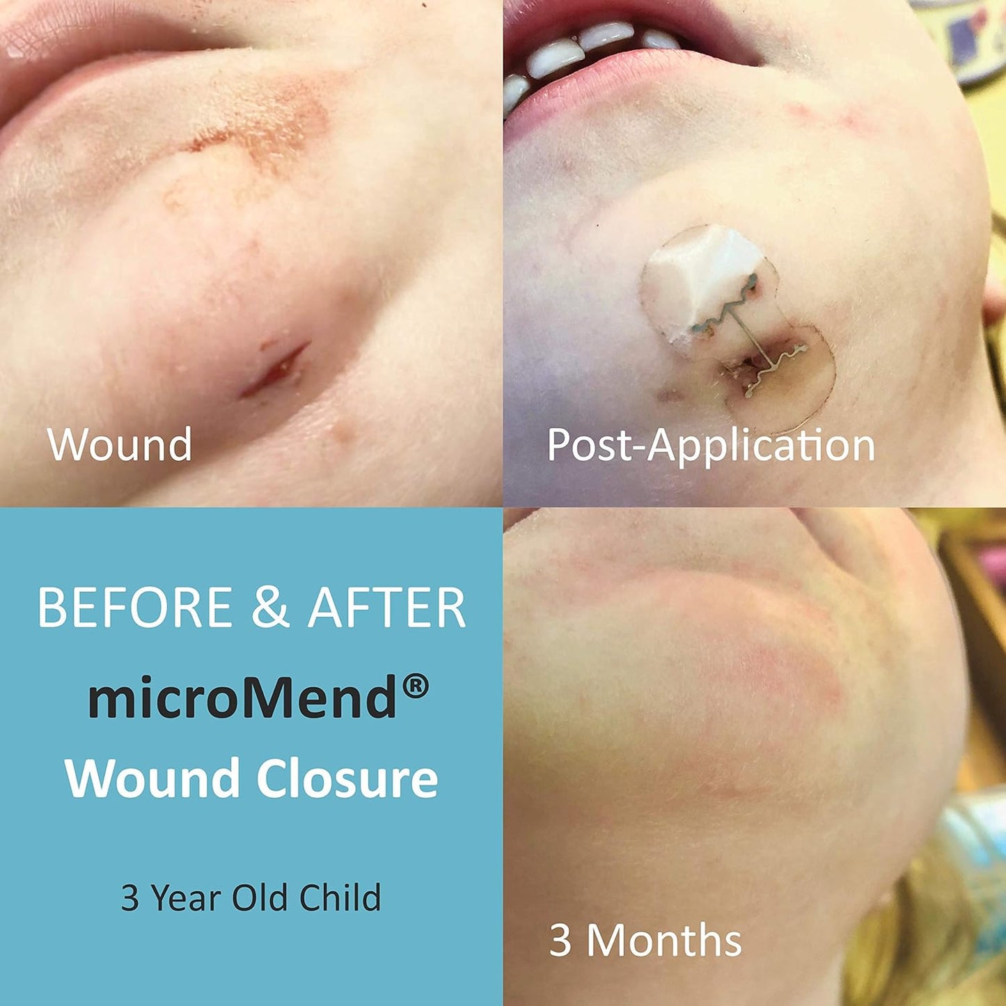Emergency Wound Closures Surgical Quality Laceration Repair Without Stitches - Think Ahead - Be Prepared - Add to Your First Aid Kit, Camping Gear (Multi Pack - 3 Packs of 2 Medium Devices)