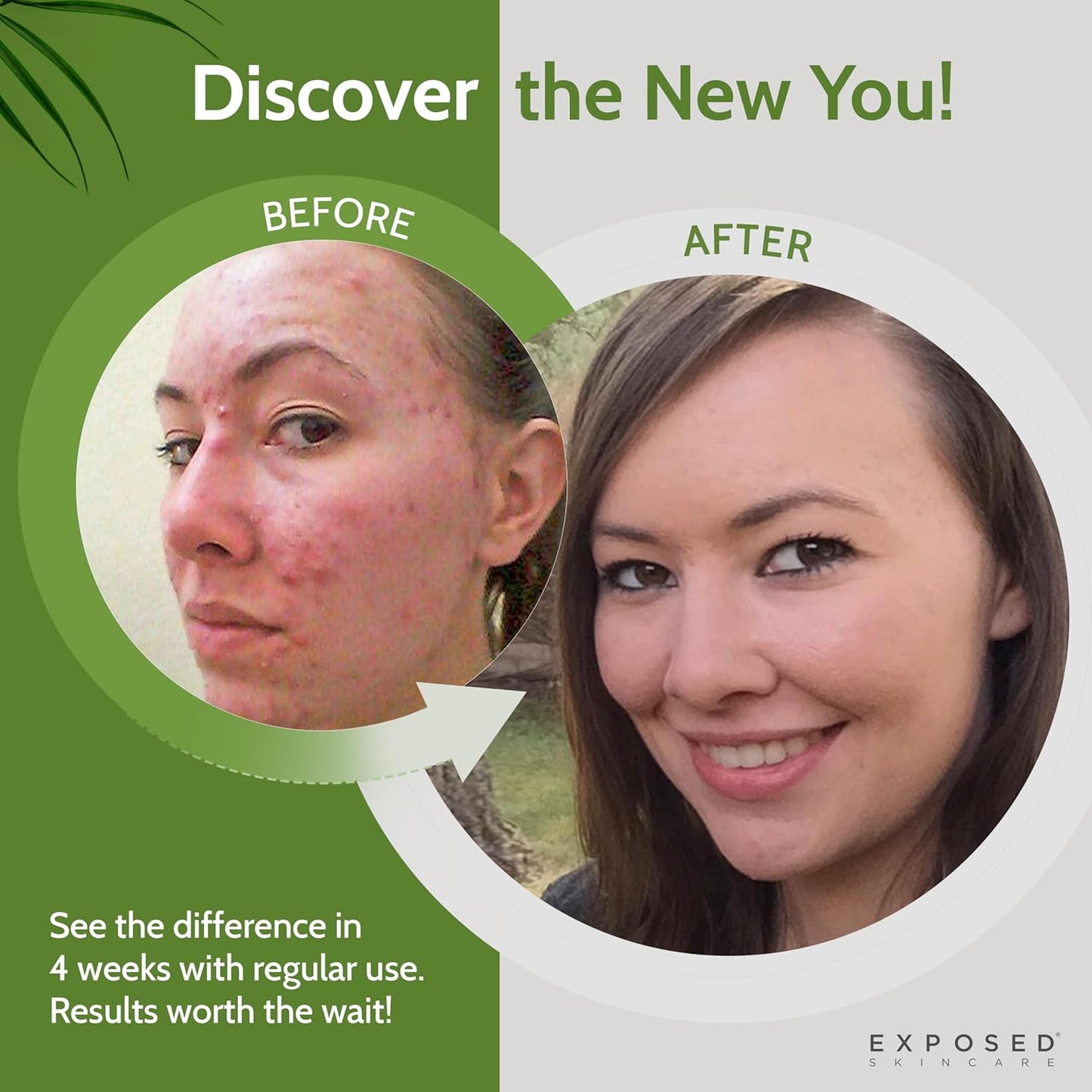 Exposed Skin Care, Expanded Acne Treatment Kit with 2.5% Salicylic Acid and 3.5% Benzoyl Peroxide to Clear Up Teen, Adult, Hormonal and Cystic Acne – Natural, Non-toxic and Cruelty Free