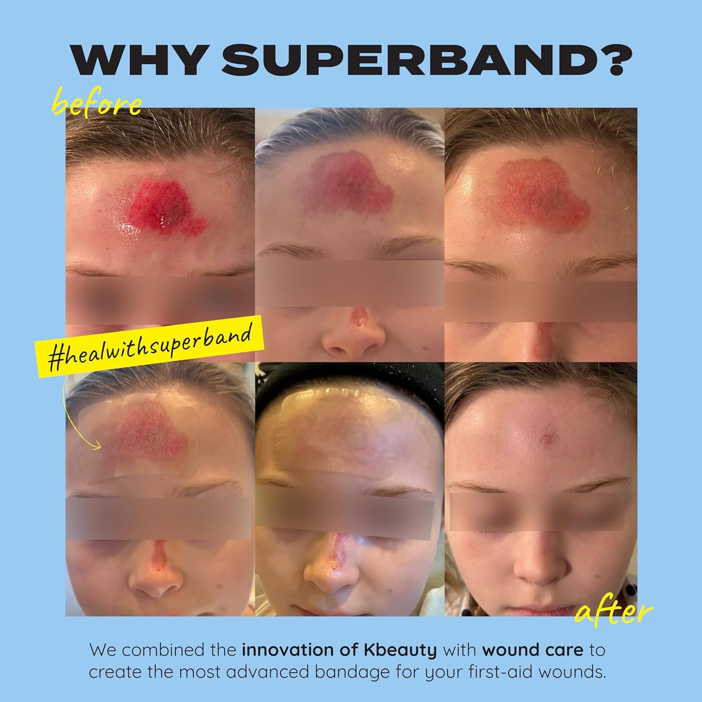 SUPERBAND Premium Hydrocolloid Bandages HSA FSA Eligble Waterproof Wound Dressing by MakeItSkin | Thin, Fast Healing, Scar Reducing for Scratches, Cuts, Burns, Blisters, Fissures, Road Rashes