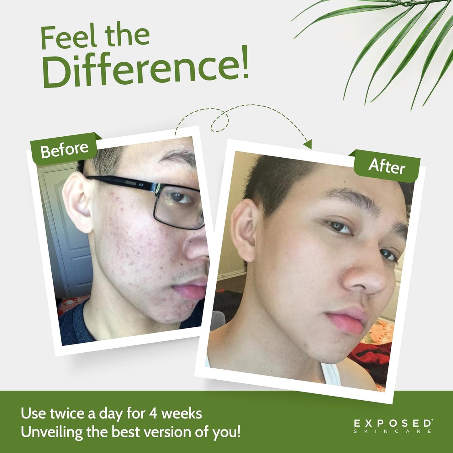 Exposed Skin Care, Basic Acne Treatment Kit with 2.5% Salicylic Acid and 3.5% Benzoyl Peroxide to Clear Up Teen, Adult, Hormonal and Cystic Acne – Natural, Non-toxic and Cruelty Free