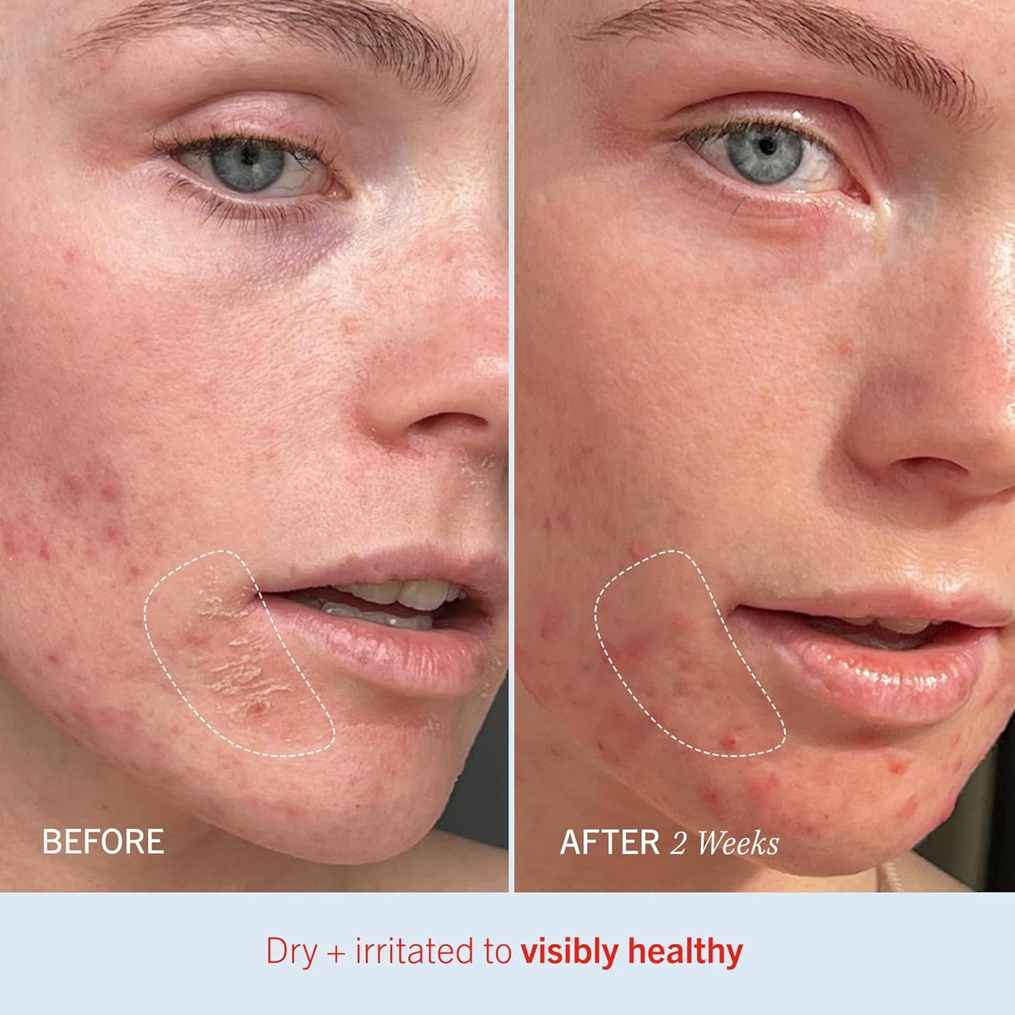 First Aid Beauty - Ultra Repair Cream, Intense Hydration Whipped Colloidal Oatmeal, Clinically Proven to Strengthen Skin Barrier in 7 Days & Helps Relieve Eczema, Luxury Face & Body Moisturizer, 14 oz