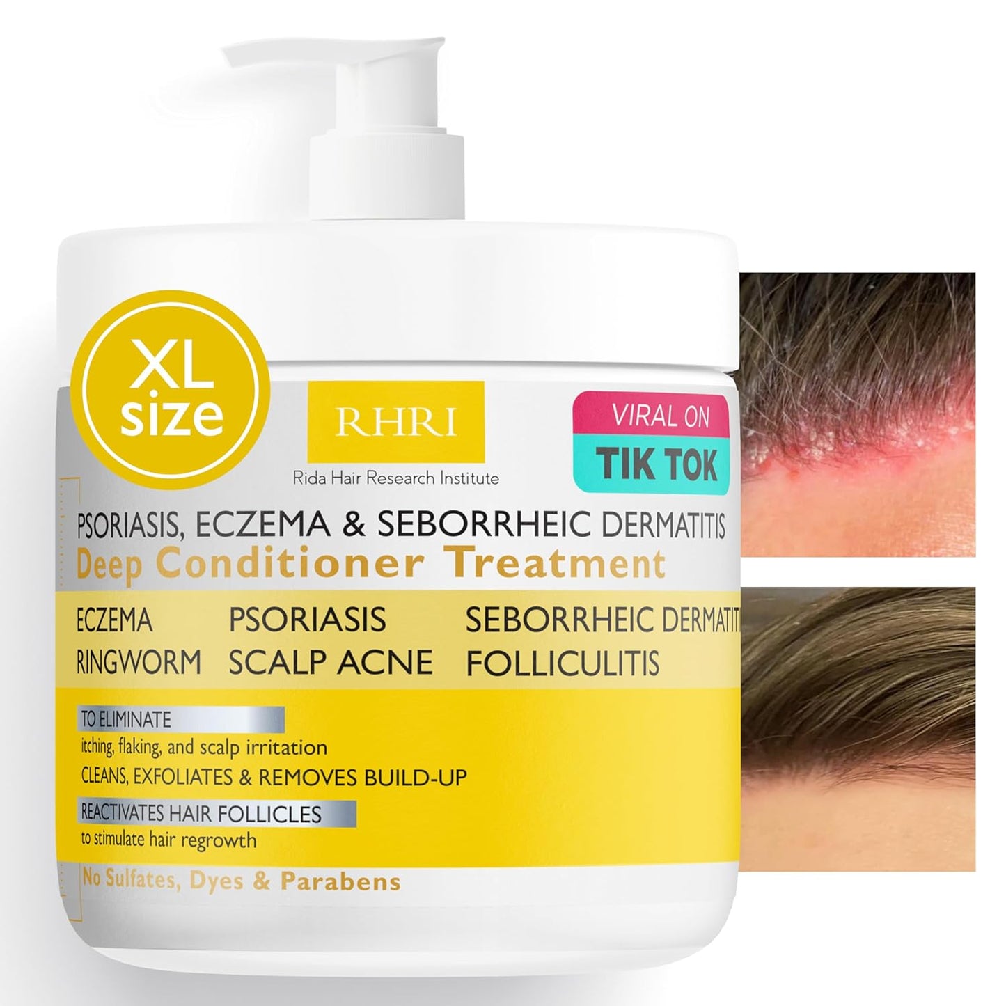 Anti Fungal Psoriasis Conditioner for Psoriasis, Eczema & Seborrheic Dermatitis | With DHT Blockers, Mineral Complex & Tea Tree Oil | Soothes Dry Itchy Scalp & Supports Hair Growth for Men & Women