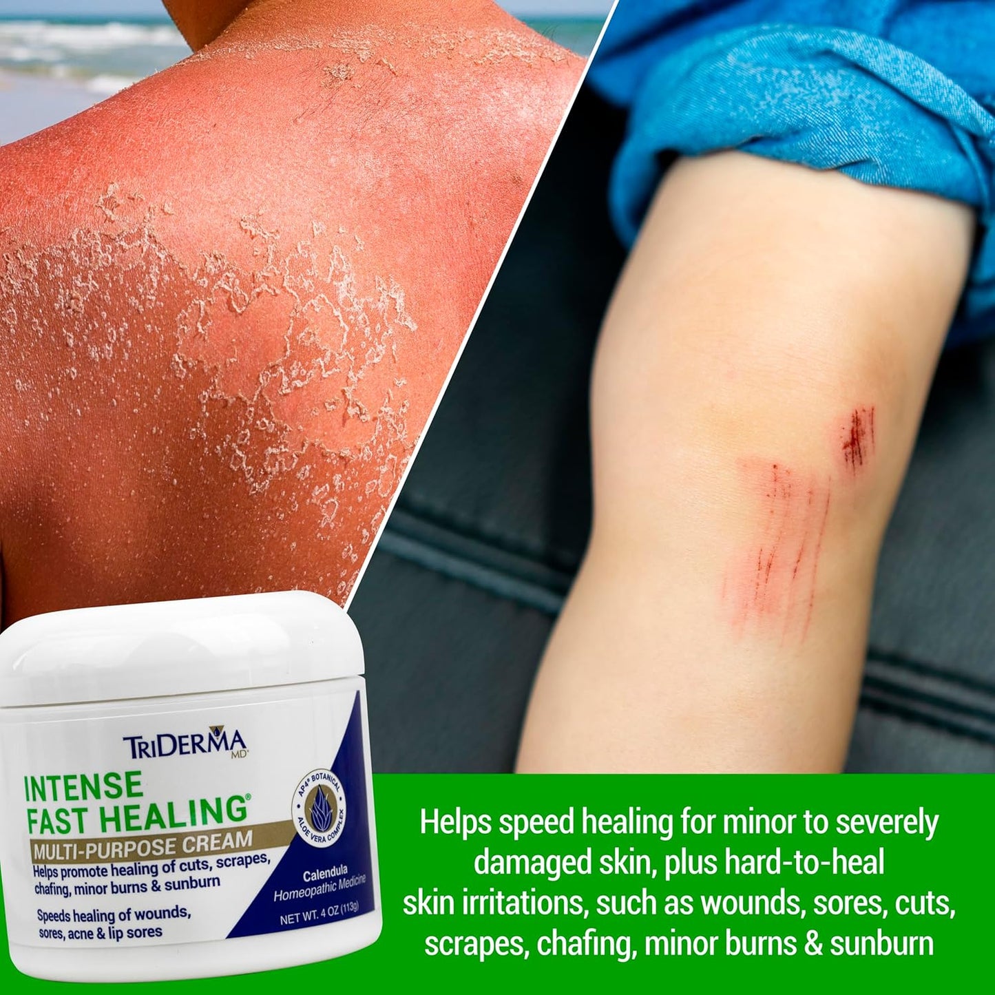 TriDerma Intense Fast Healing Cream, Decreases Healing Time for Minor Irritations, Rashes, Scrapes, Cuts 4 Ounces